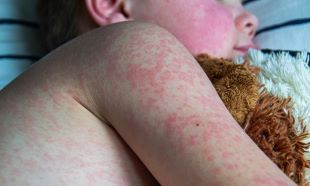 child with measles